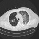 H1N1, atypical pneumonia, superinfection, follow-up: CT - Computed tomography